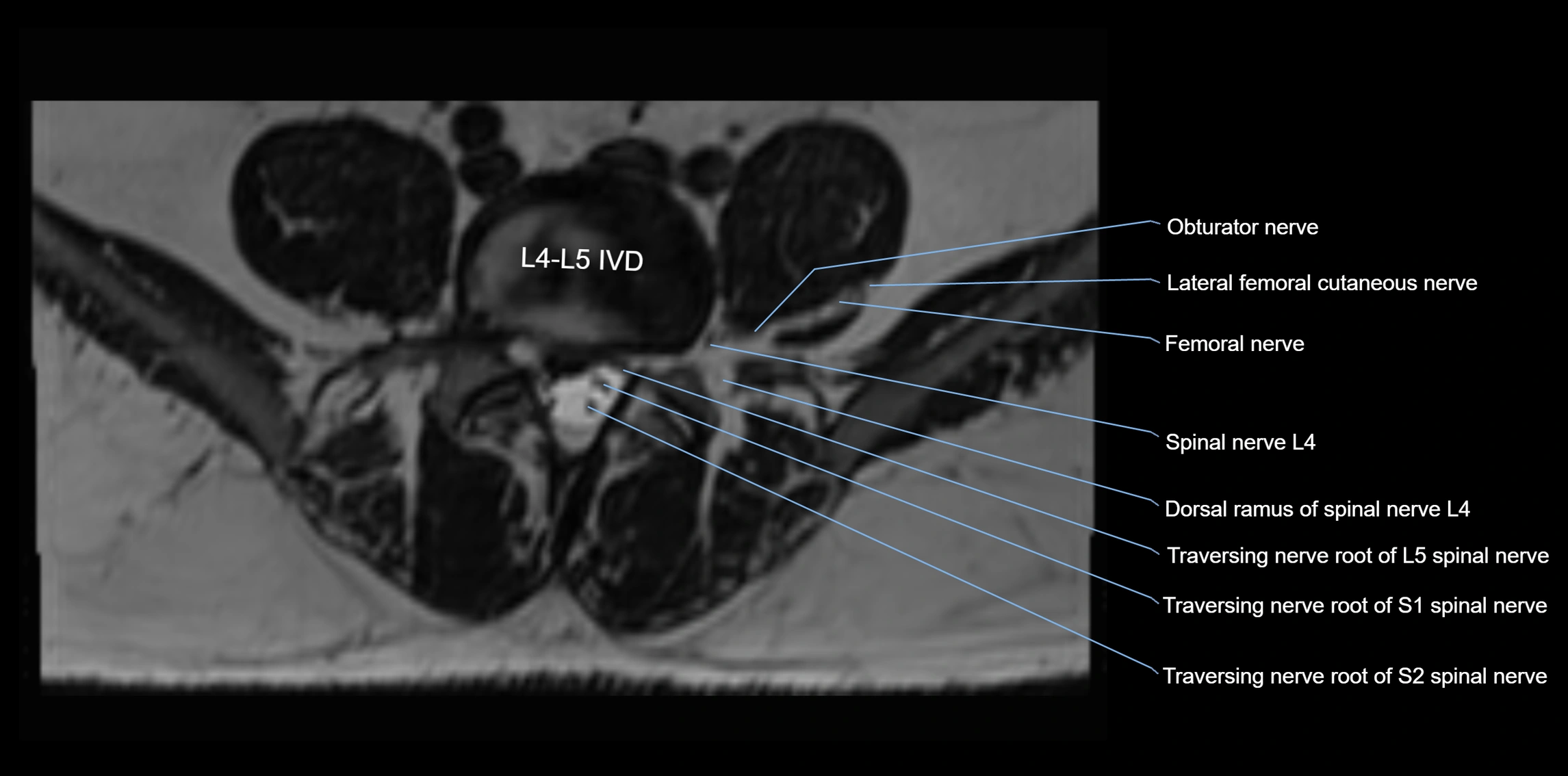 MR lumbosacral plexus axial cross sectional anatomy 3T  radiology  image-img-1008001-00050.webp